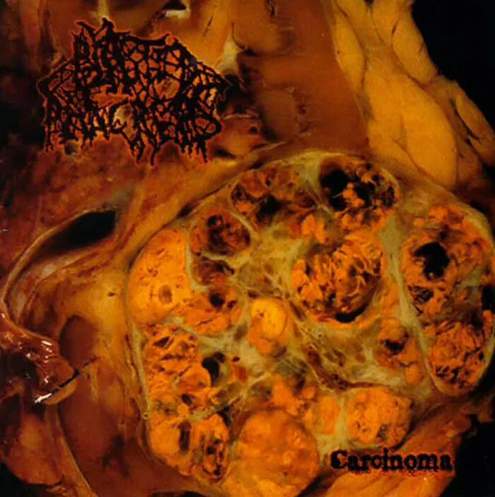 Carcinoma cover