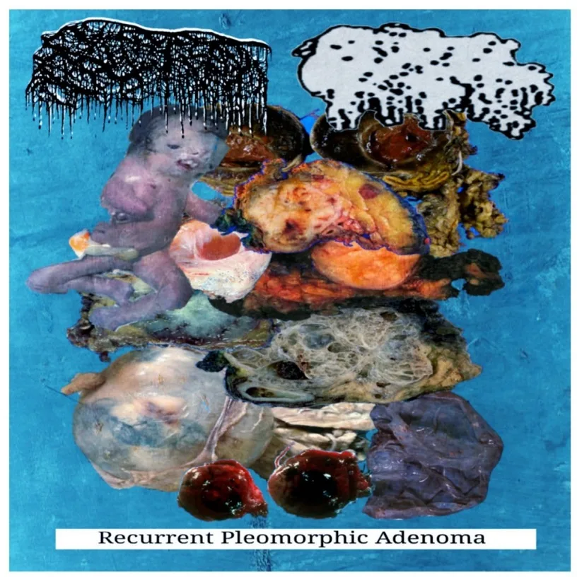 Bloat / Calcified Fetus cover