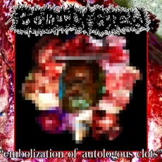 Embolization of Autologous Clots cover