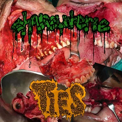 Total Maxillectomy cover