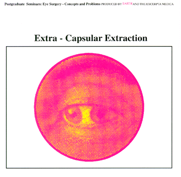 Extra-Capsular Extraction cover