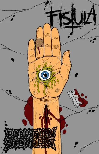 Fistula / Radiation Sickness cover