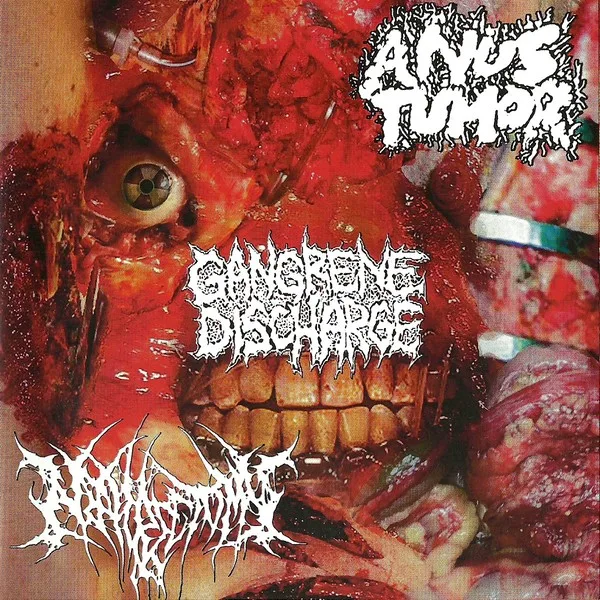 Anus Tumor / Nephrectomy / Gangrene Discharge cover