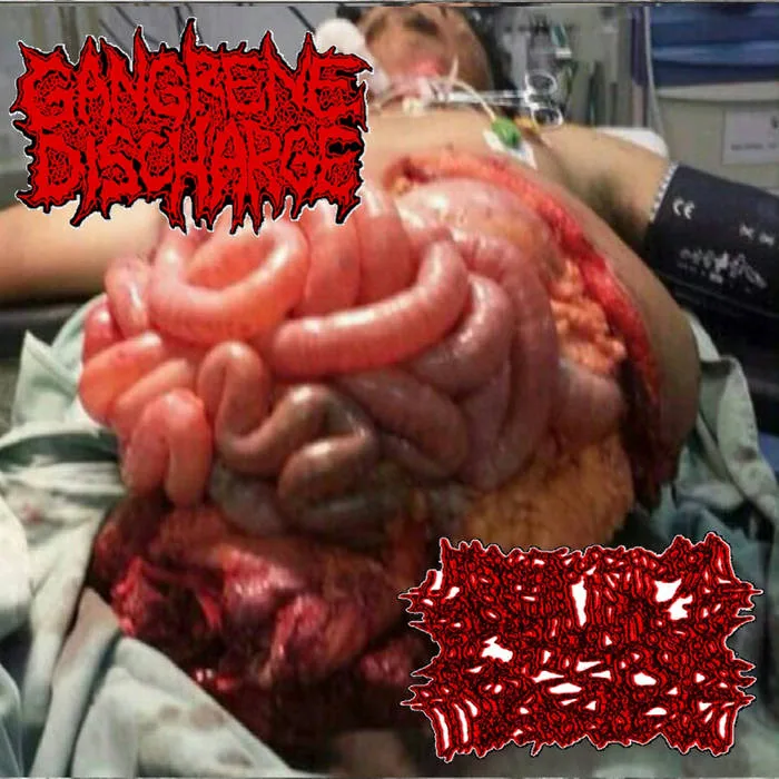 Extricated Bowel Rupture / Duodenojejunal Loop with Associated Clockwise Midgut Volvulus cover