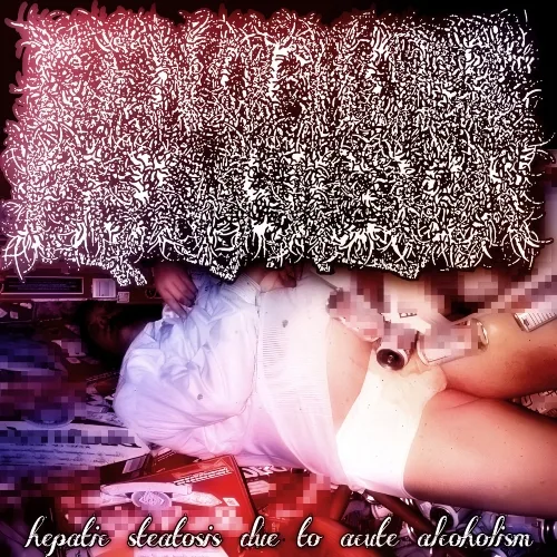 Hepatic Steatosis Due to Acute Alcoholism cover