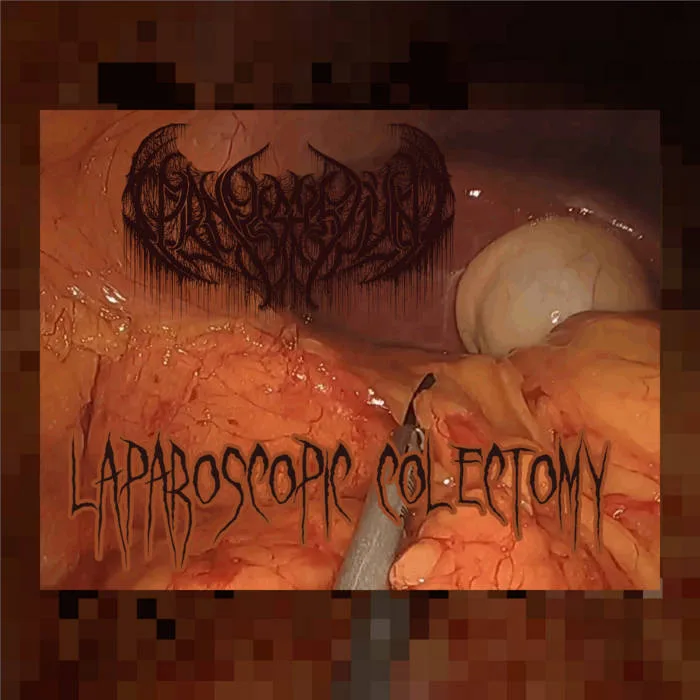 Laparoscopic Colectomy cover