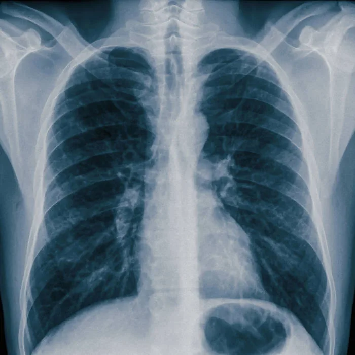 Lung cover