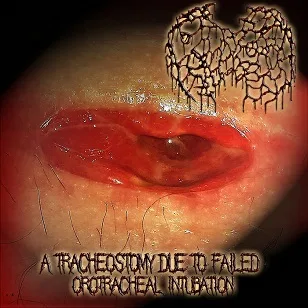 A Tracheostomy Due to Failed Orotracheal Intubation cover