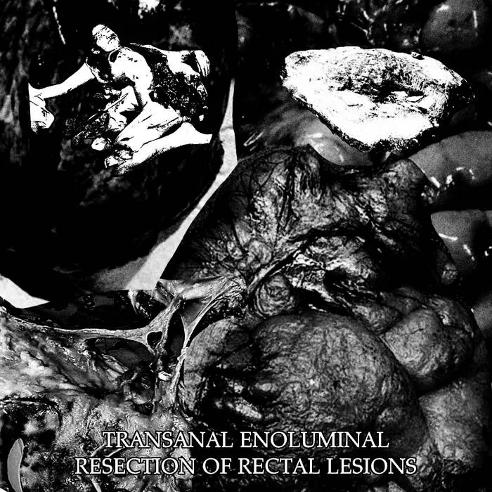 Transanal Enoluminal Resection of Rectal Lesions cover