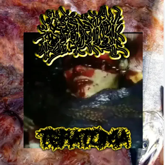 Teratoma cover