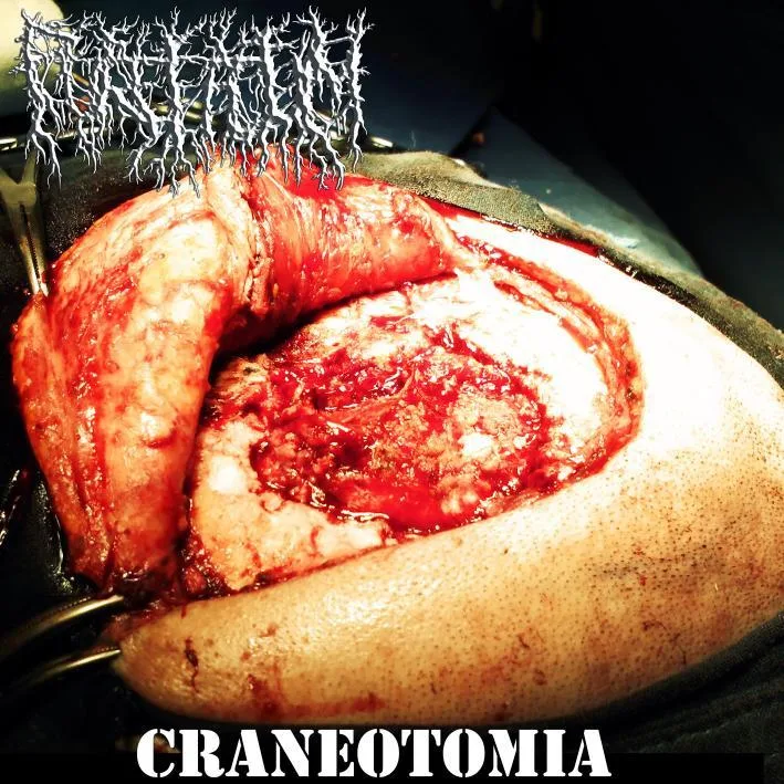 Craneotomía cover