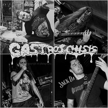 Gastroschisis